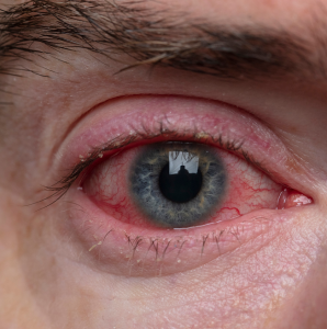 מחלות דלקתיות של פני שטח העין